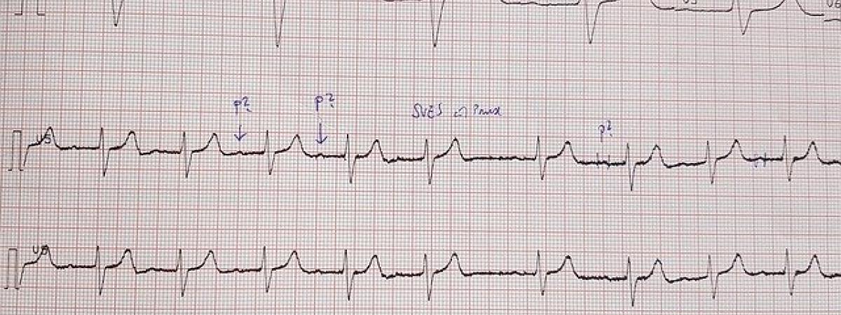 what-you-need-to-know-about-heart-palpitations-hchc